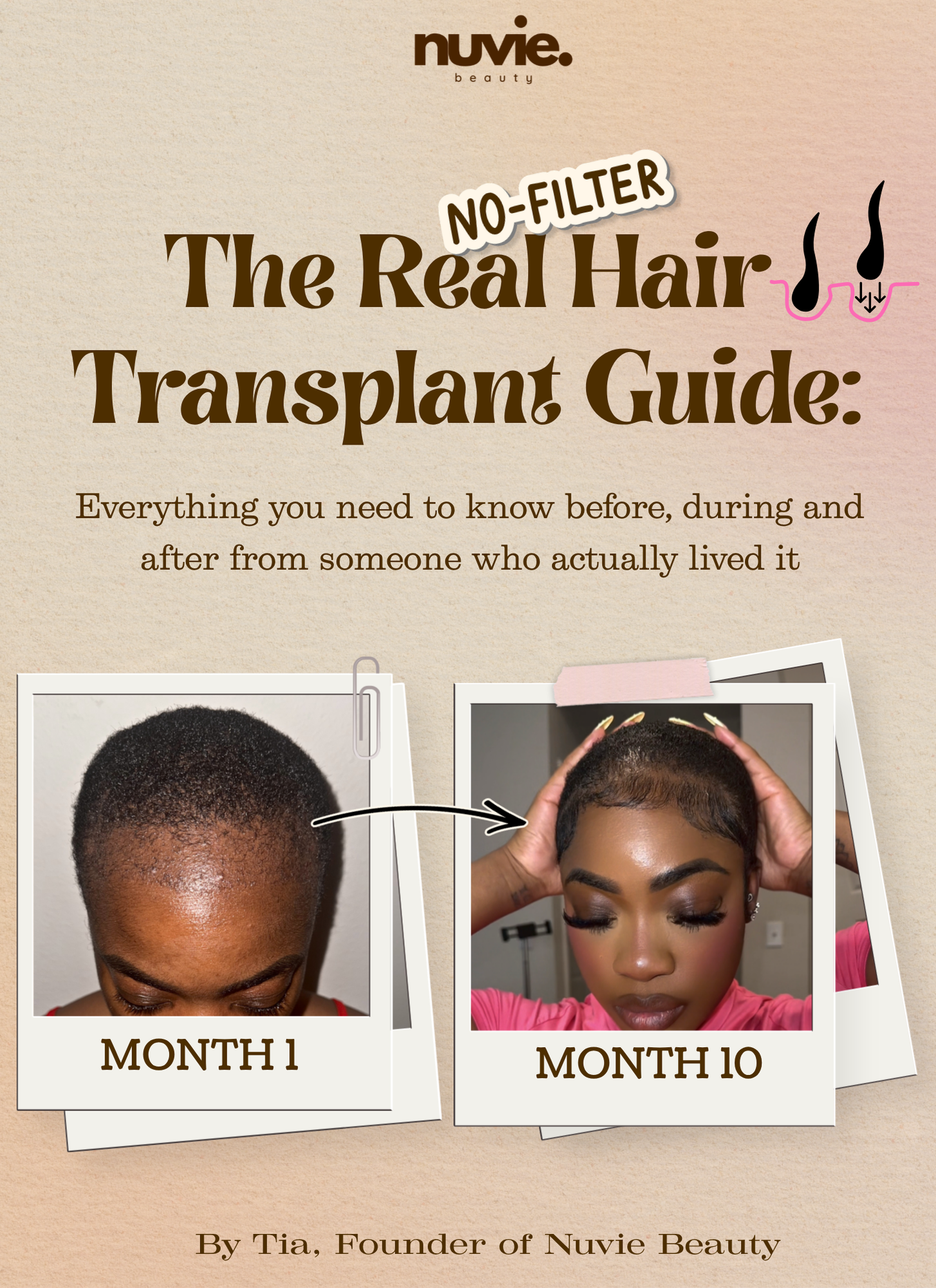 The Real Hair Transplant Guide — Free Teaser