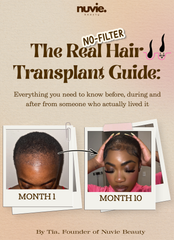 The Real Hair Transplant Guide — Full Guide
